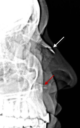 FRATURA DO OSSO NASAL