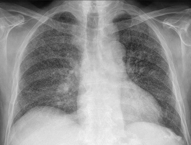 TORAX – HEPATOMEGALIA