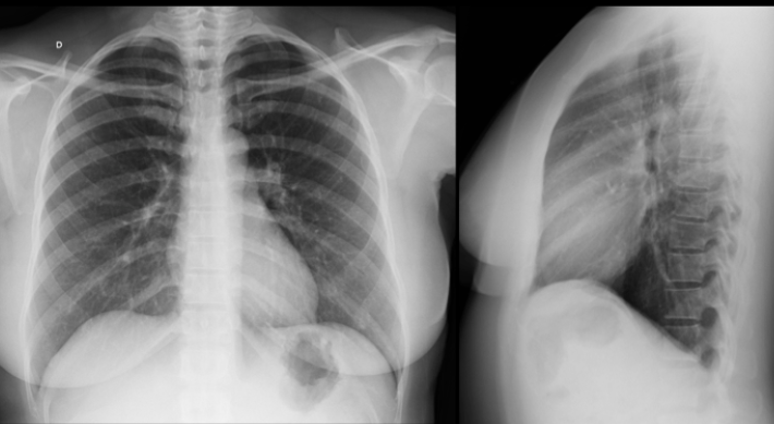 A IMPORTANCIA DO RX TORAX PA/LATERAL NO PRÉ – OPERATÓRIO