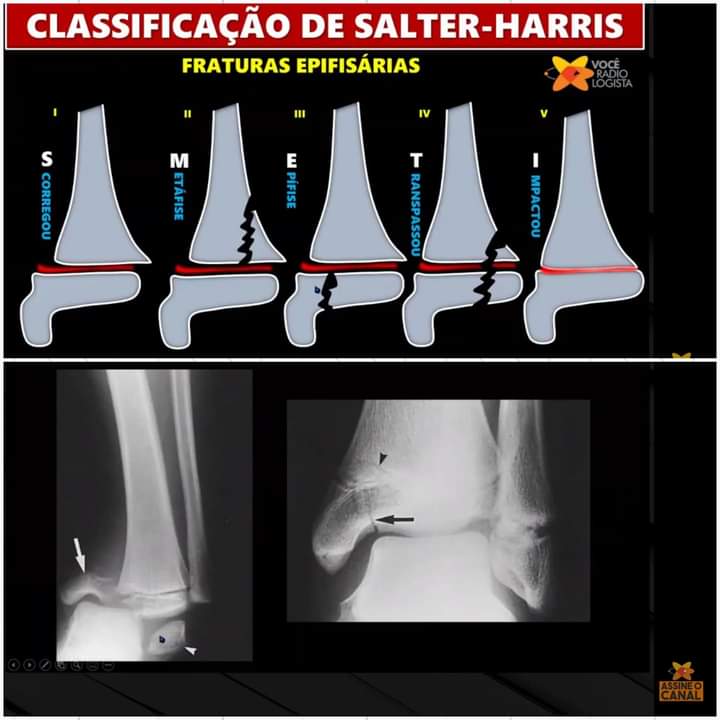 CLASSIFICAÇÃO DE FRATURAS SALTER-HARRIS