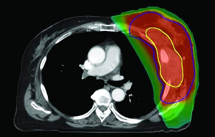 TRATAMENTO DE SARCOMA