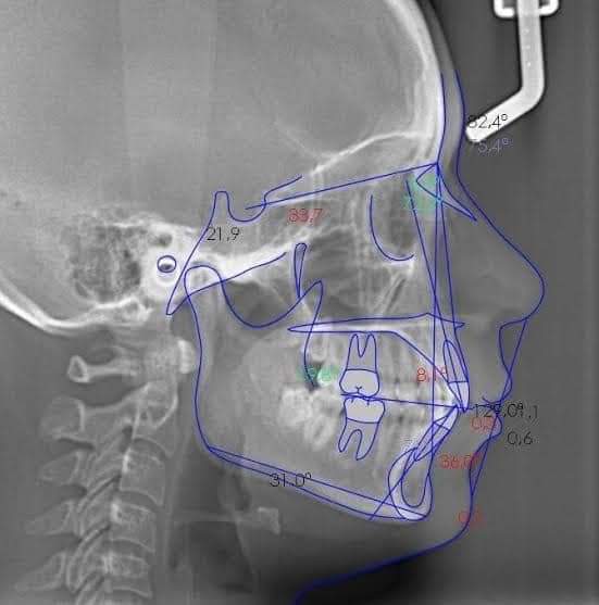 CEFALOMETRIA RADIOLOGIA ODONTOLÓGICA