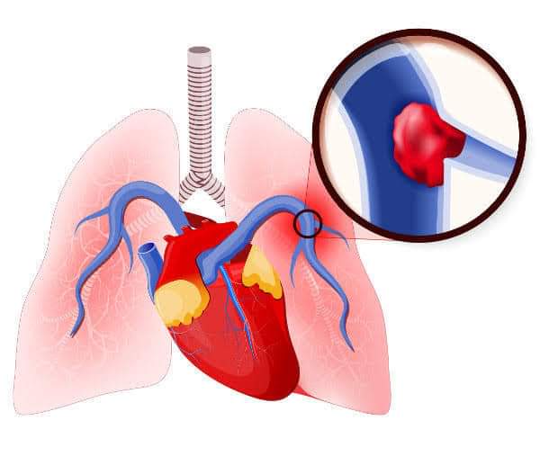 EMBOLIA PULMONAR