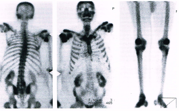 Cintilografia Óssea