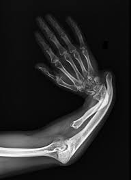 HEMIMELIA ULNAR